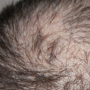How To Treat Thinning Hair - Moore Unique Skin Care