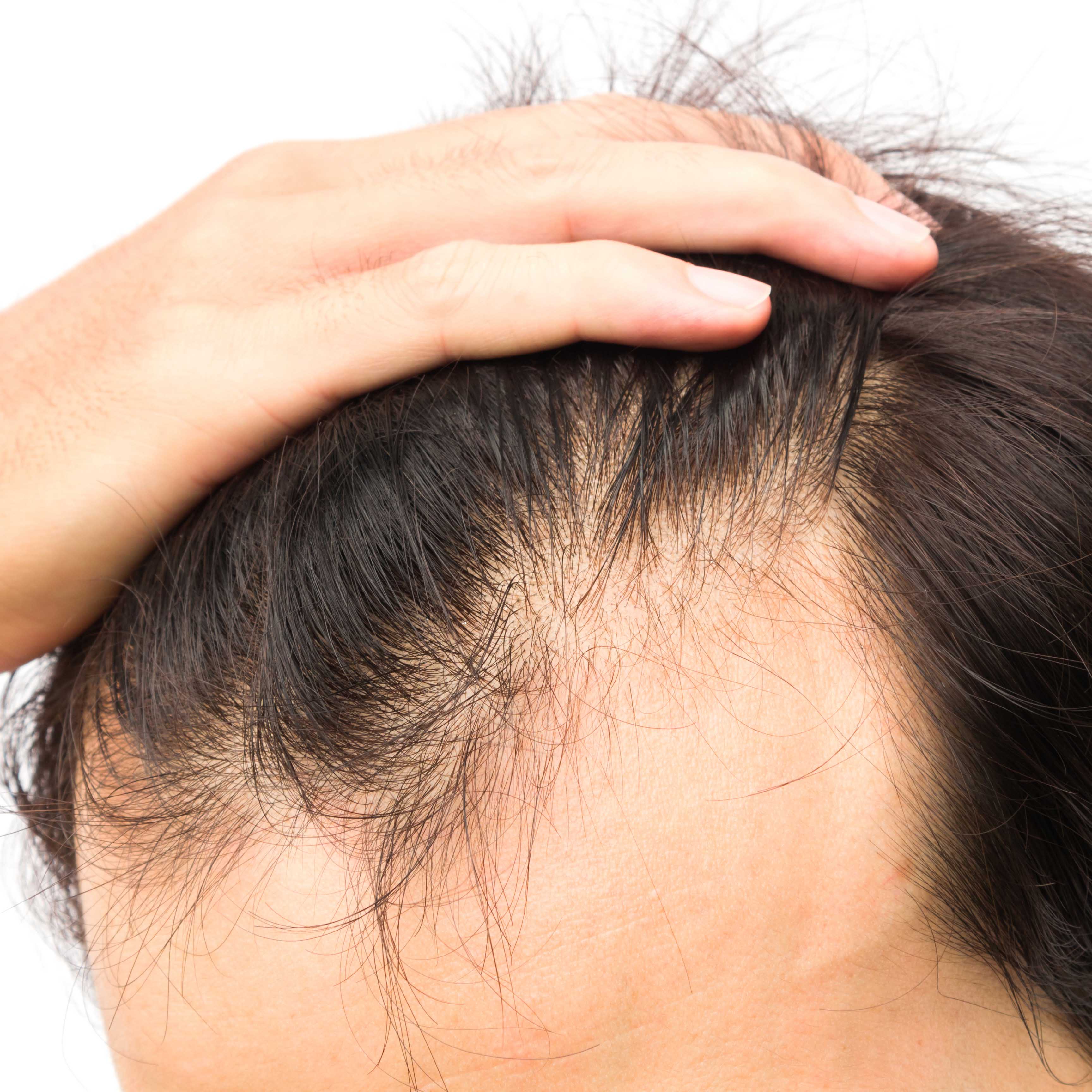 How To Stop Hair Loss Moore Unique Skin Care